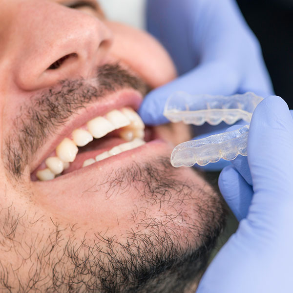 Invisible braces